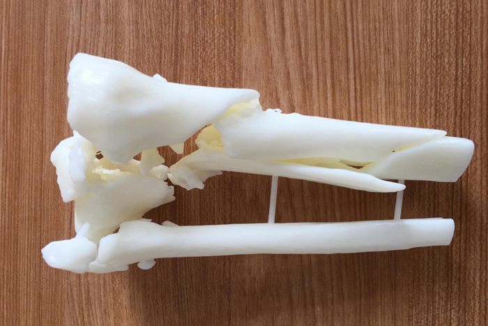 定制式3D打印医学模型
