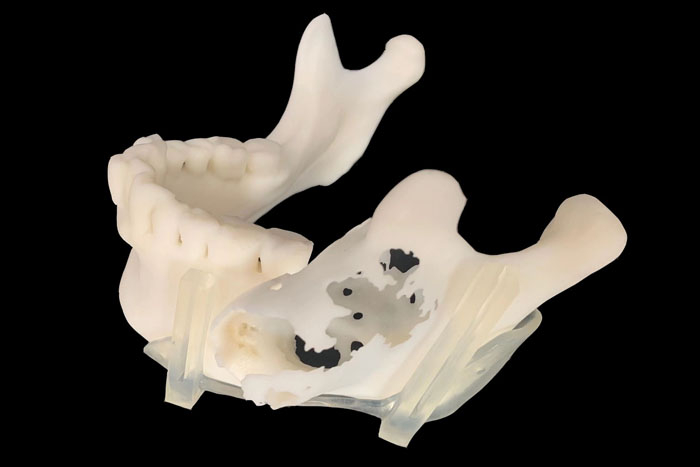 定制式3D打印医学模型