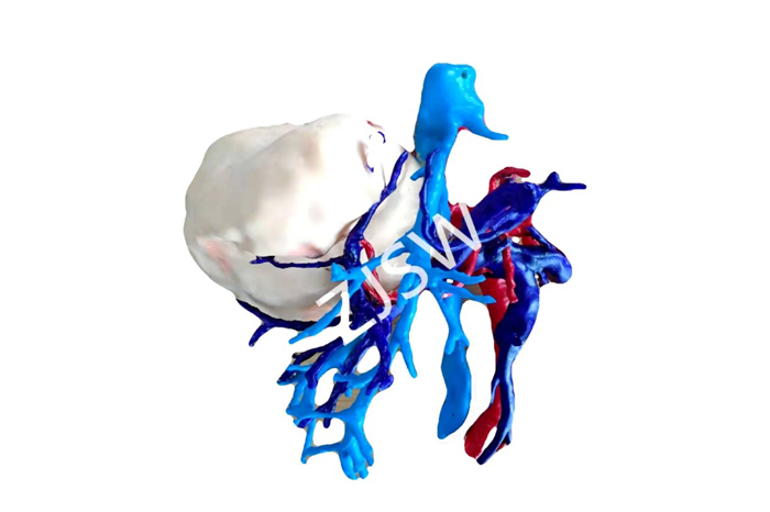 定制式3D打印医学模型