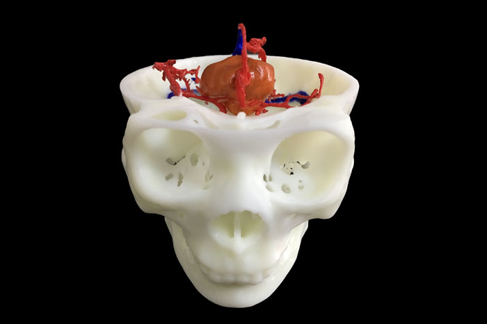 定制式3D打印医学模型